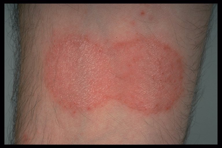 discoid eczema treatments