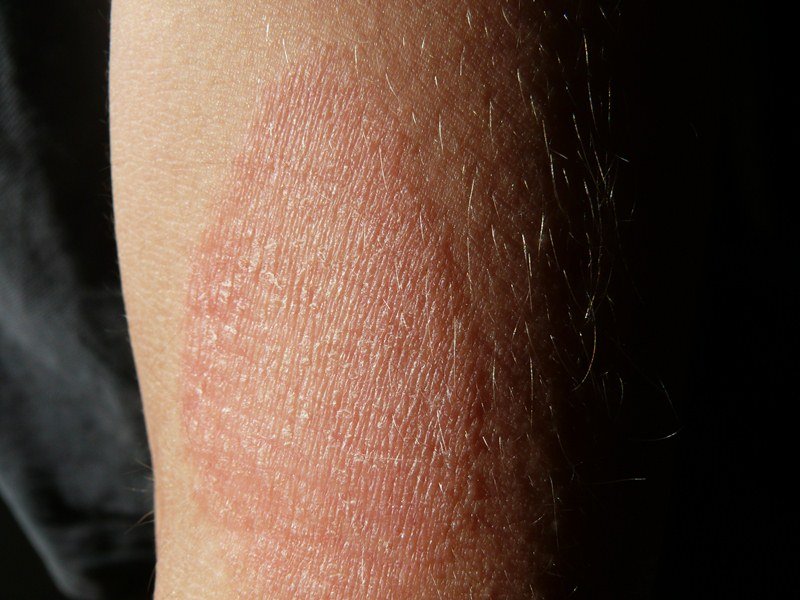 Discover the Most Common Eczema Myths and Find Out If They ...