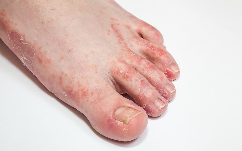 Disease Graphics, Videos &  Images on Eczema