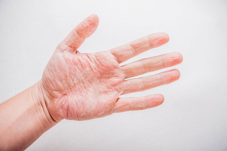 Do I have eczema? Symptoms and types of atopic dermatitis ...