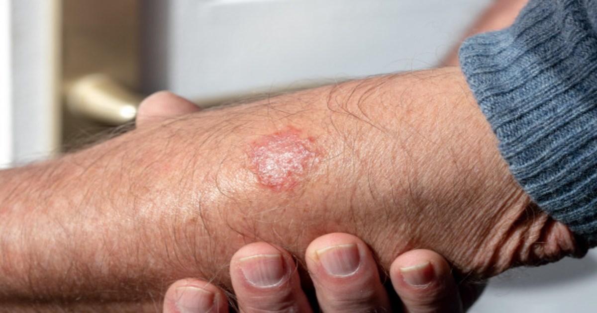 Do You Have Eczema? The Symptoms Discussed