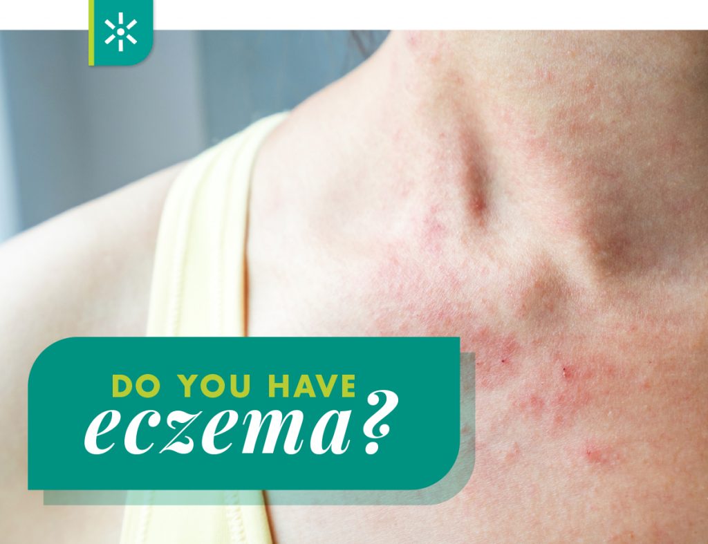 What Can You Put On Eczema To Stop The Itch