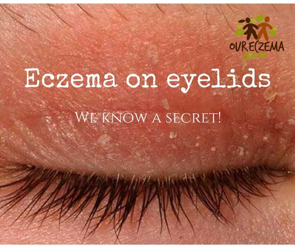 Do you suffer from eczema or dry eyelids? Then read our family secret ...