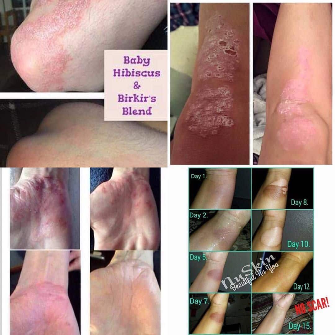 Do you suffer from sore flaky skin/eczema or psoriasis? Have you tried ...