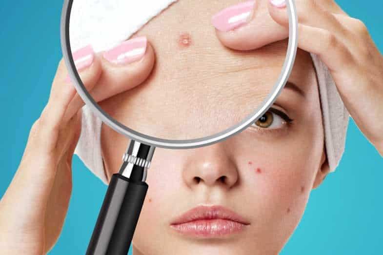 Does Acne Go Away Naturally? Plus 5 Tips