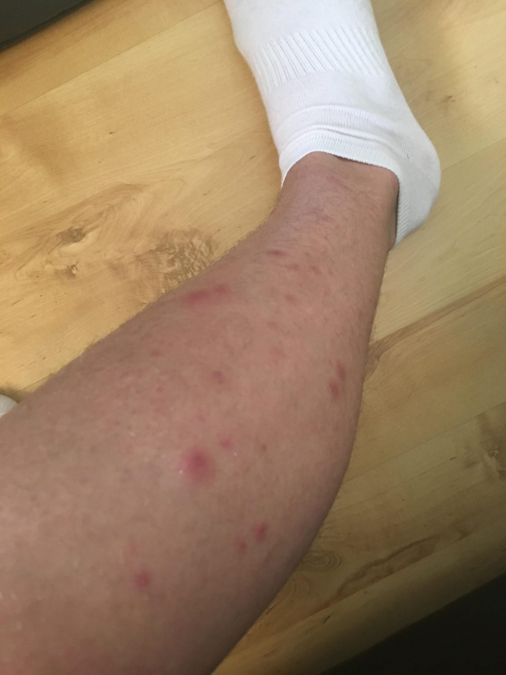 Does anyone else get spots where their eczema has been after it has ...