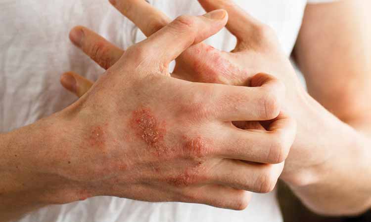 DOES ECZEMA FLARE UP IN SUMMER? CONTROL IT.