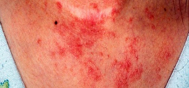 Does Eczema Itch Really Bad