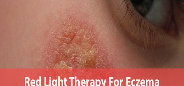 Does Red Light Therapy Work For Eczema
