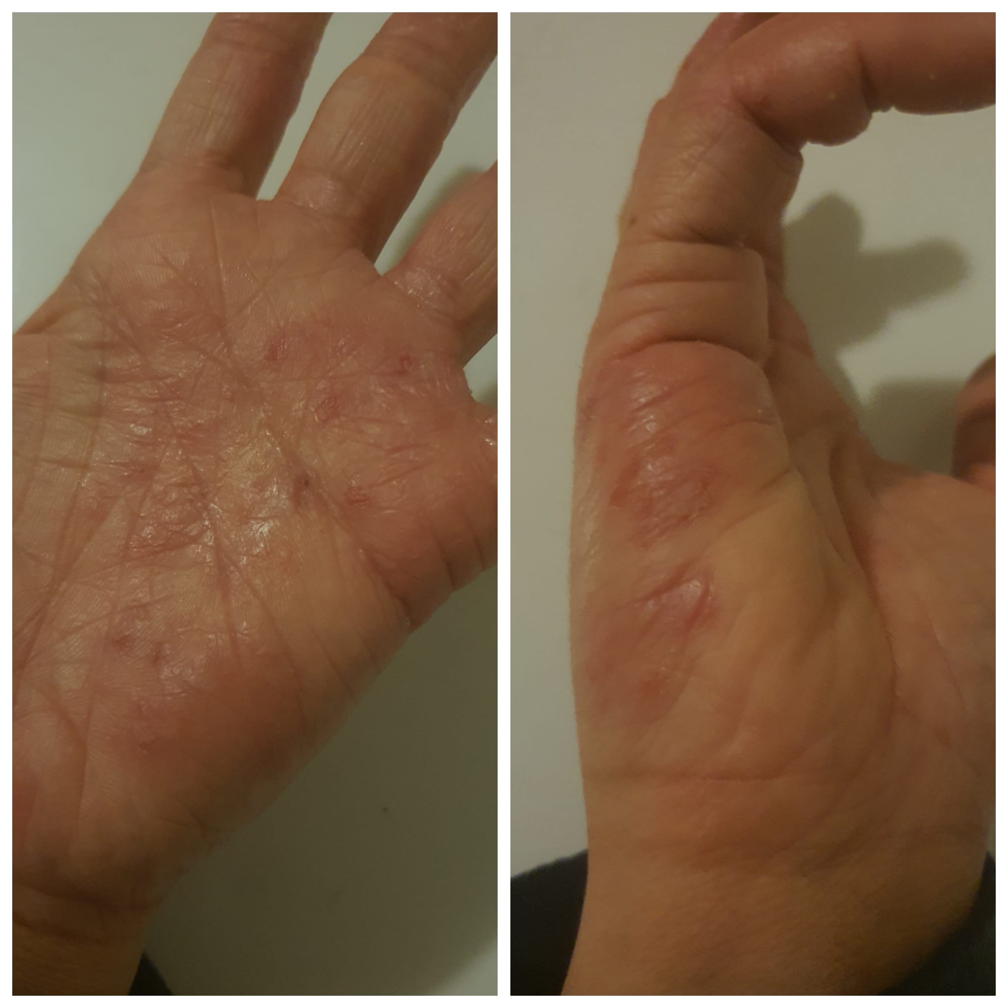 Does this look like dyshidrotic eczema? Or does anyone elses do this ...