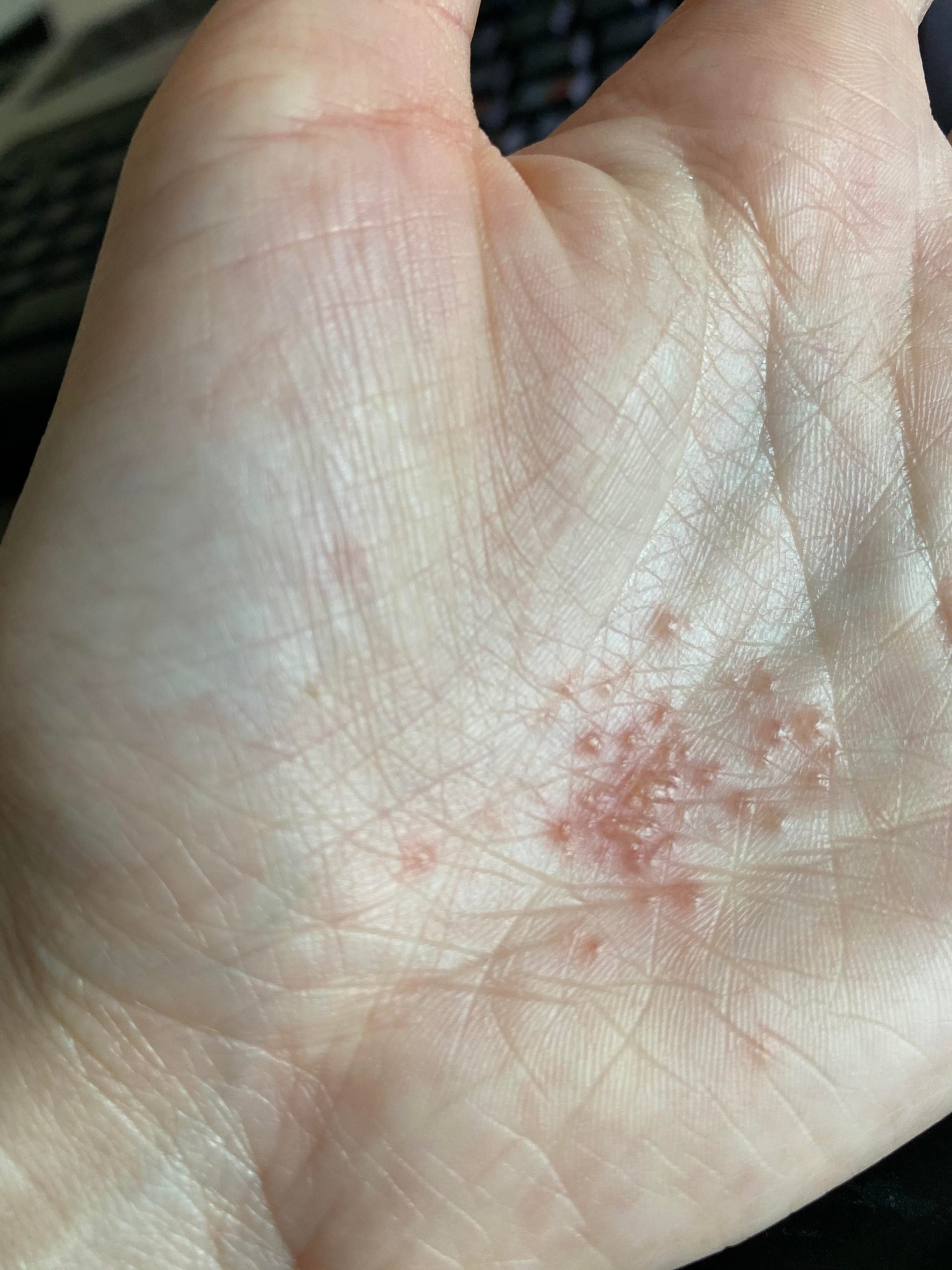 Does this look like eczema? I thought it may be scabies ...