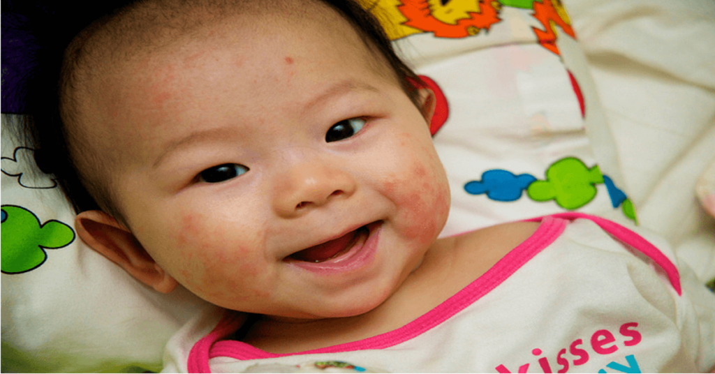 Does your baby suffer from Eczema? Check out these tips ...