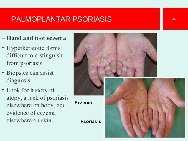[Download 27+] Vs Eczema Mild Psoriasis On Hands