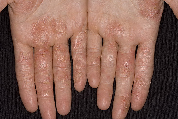 Dry Eczema on Hands Pictures  475 Photos &  Images ...