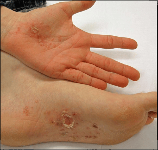 Dyshidrotic eczema (Dyshidrosis): Symptoms, Causes, Treatment and ...