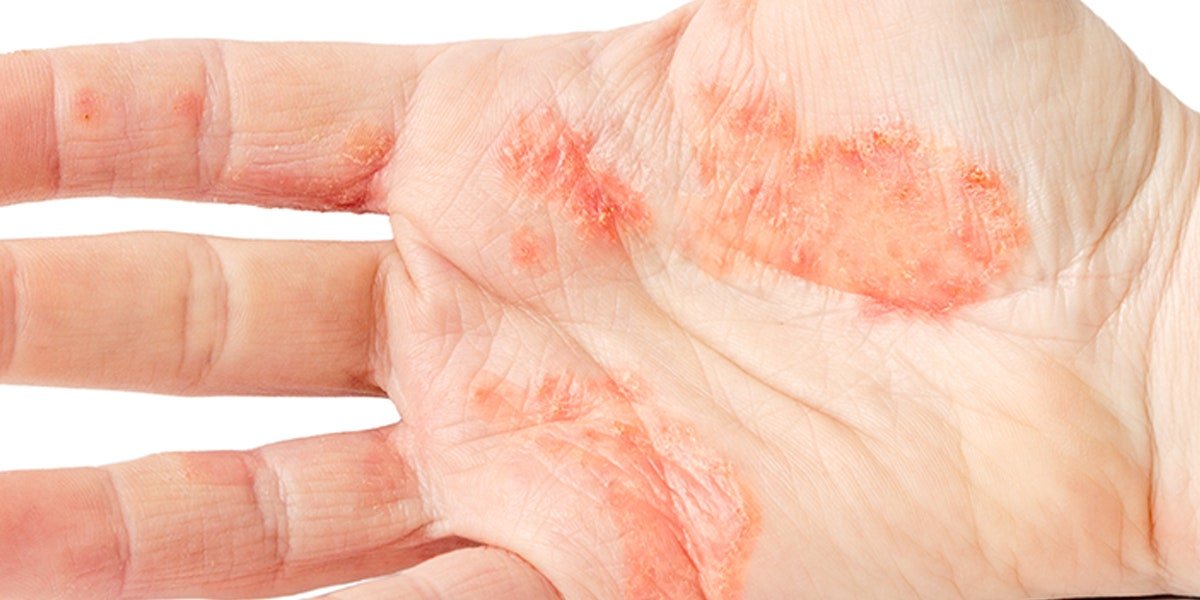 Dyshidrotic Eczema: How to Tell If Your Blisters Are This Condition