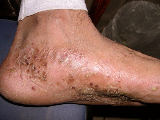 Dyshidrotic Eczema on the feet