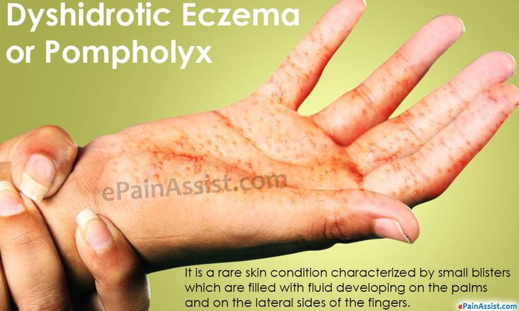 Dyshidrotic Eczema or Pompholyx Read: http://www ...