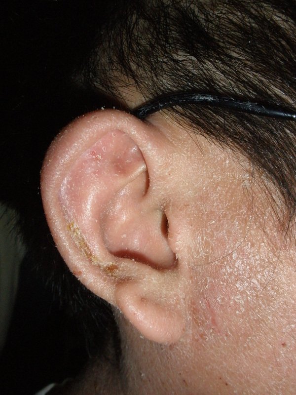 ear eczema Gallery