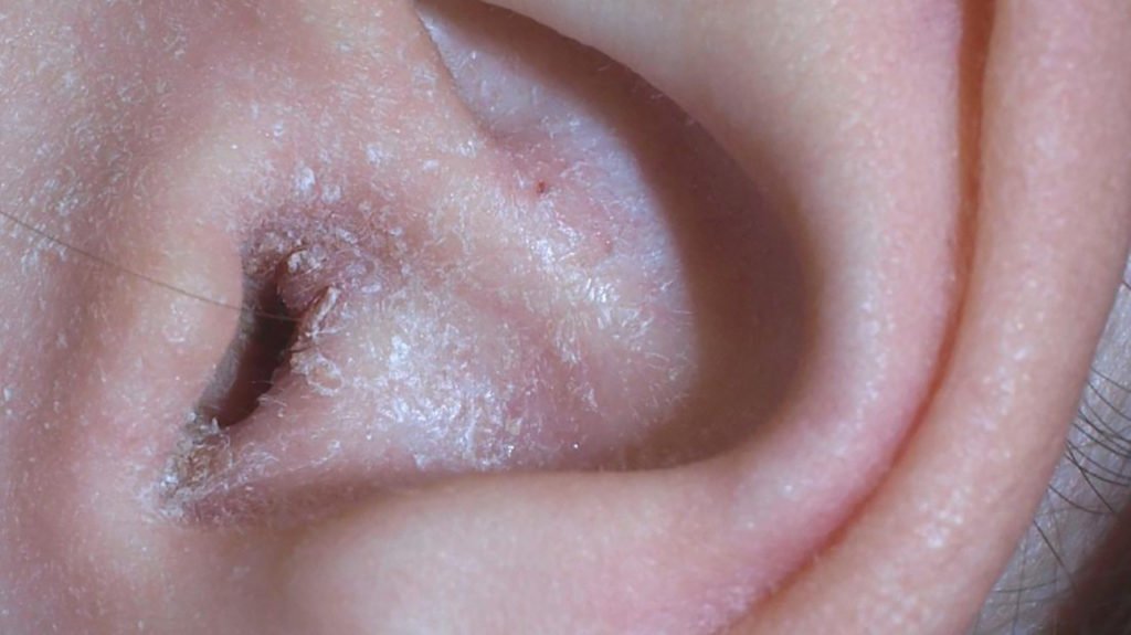 Ear eczema: Symptoms, causes, and treatment