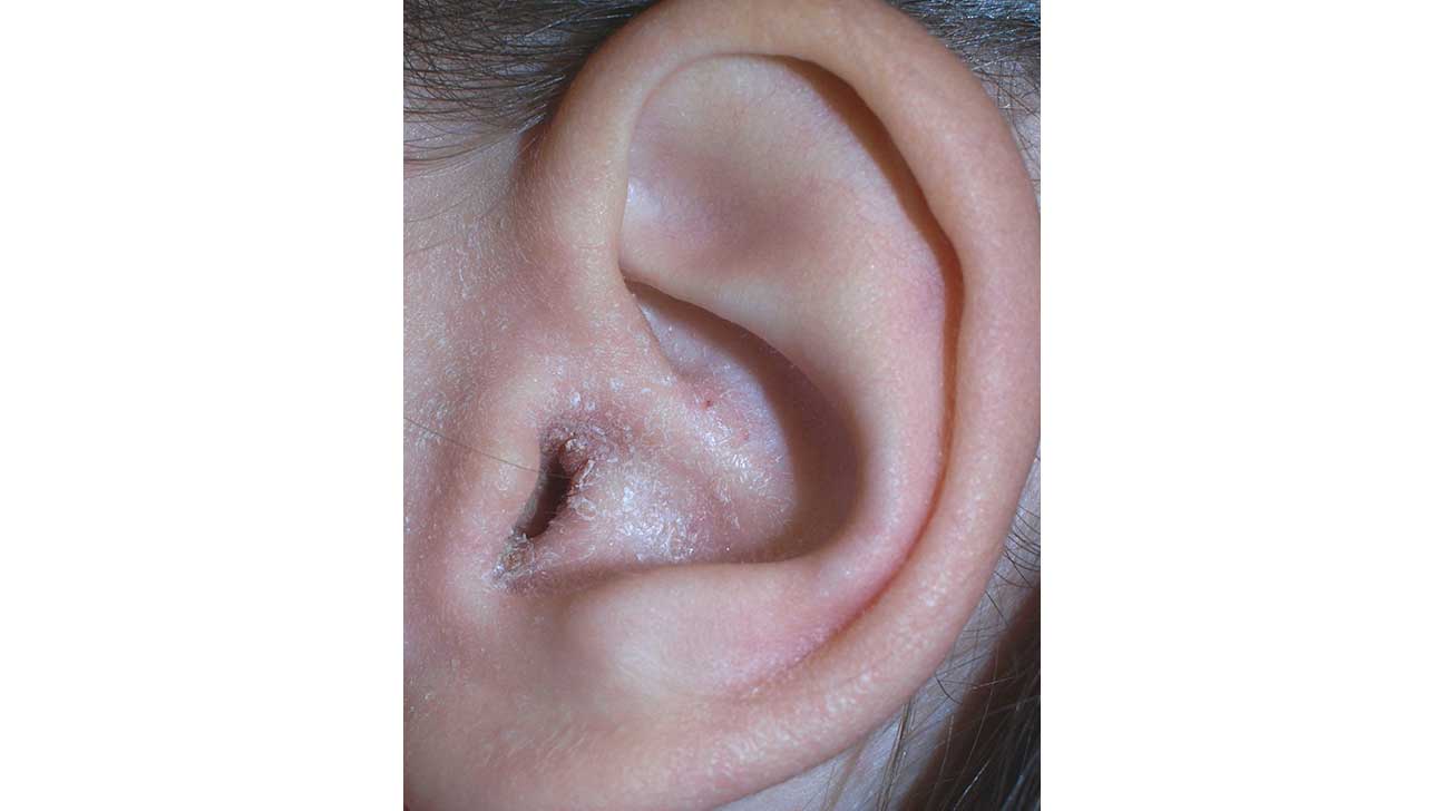 Ear Eczema: Symptoms, Causes, Diagnosis, Treatment ...