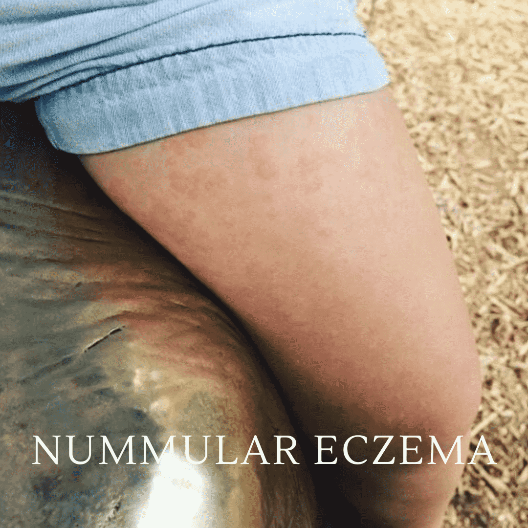Eczema a problem which can be prevented