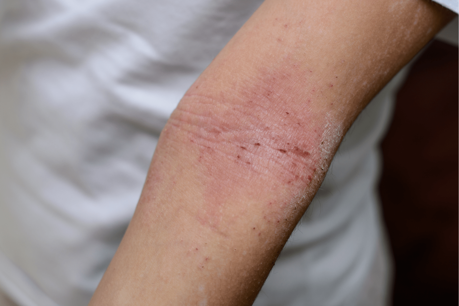 Eczema â www.urgentcarebear.com