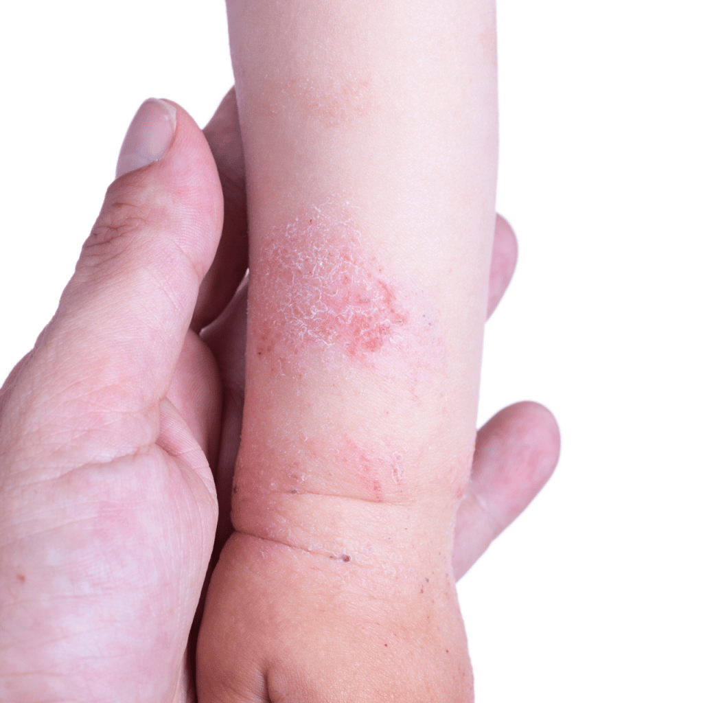 Eczema advice for the Winter  get your happy baby back!