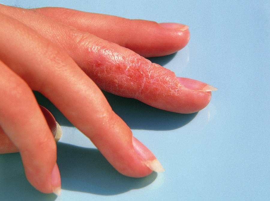Eczema Affecting A Womans