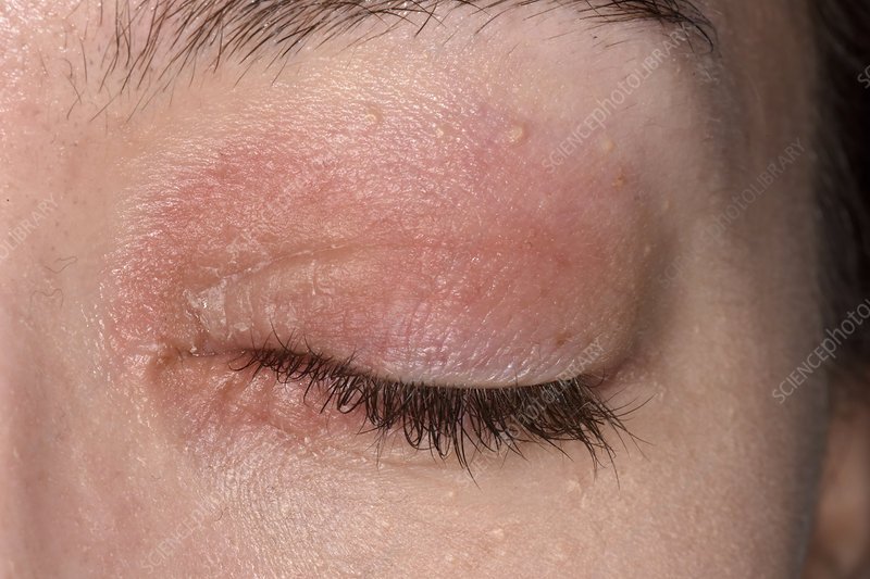 Eczema affecting the eyes