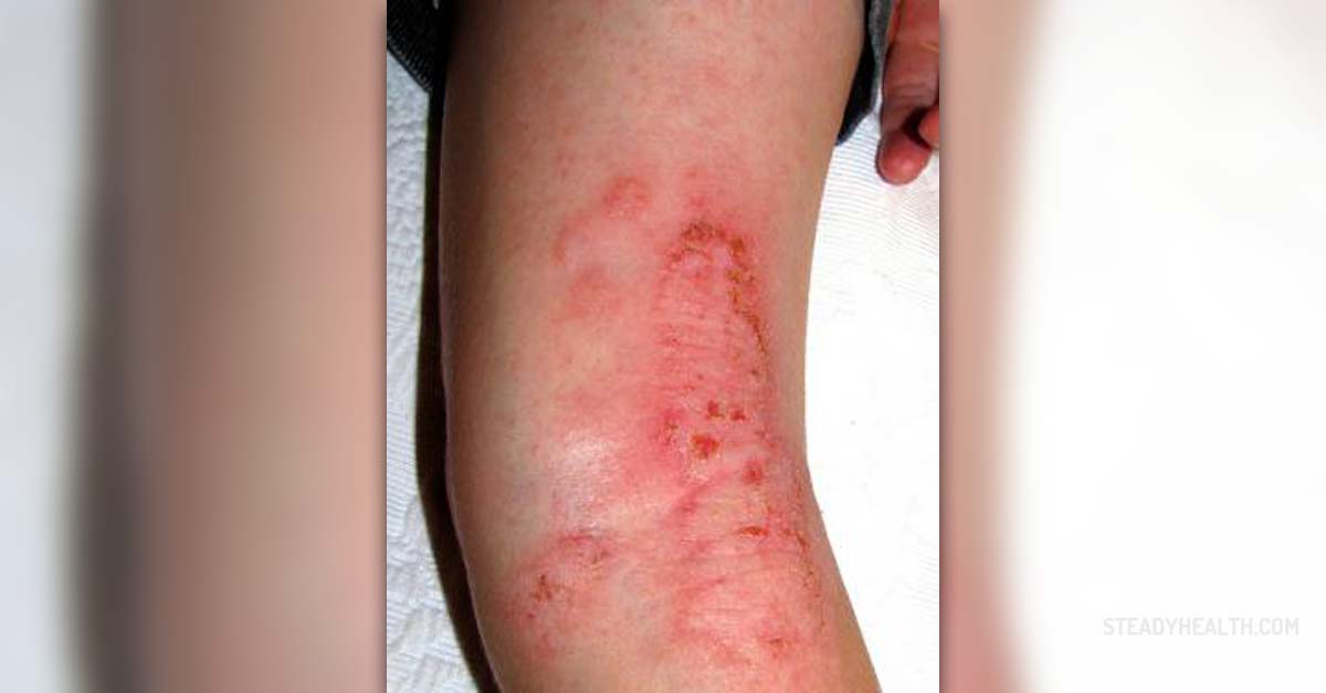 Eczema and food allergies
