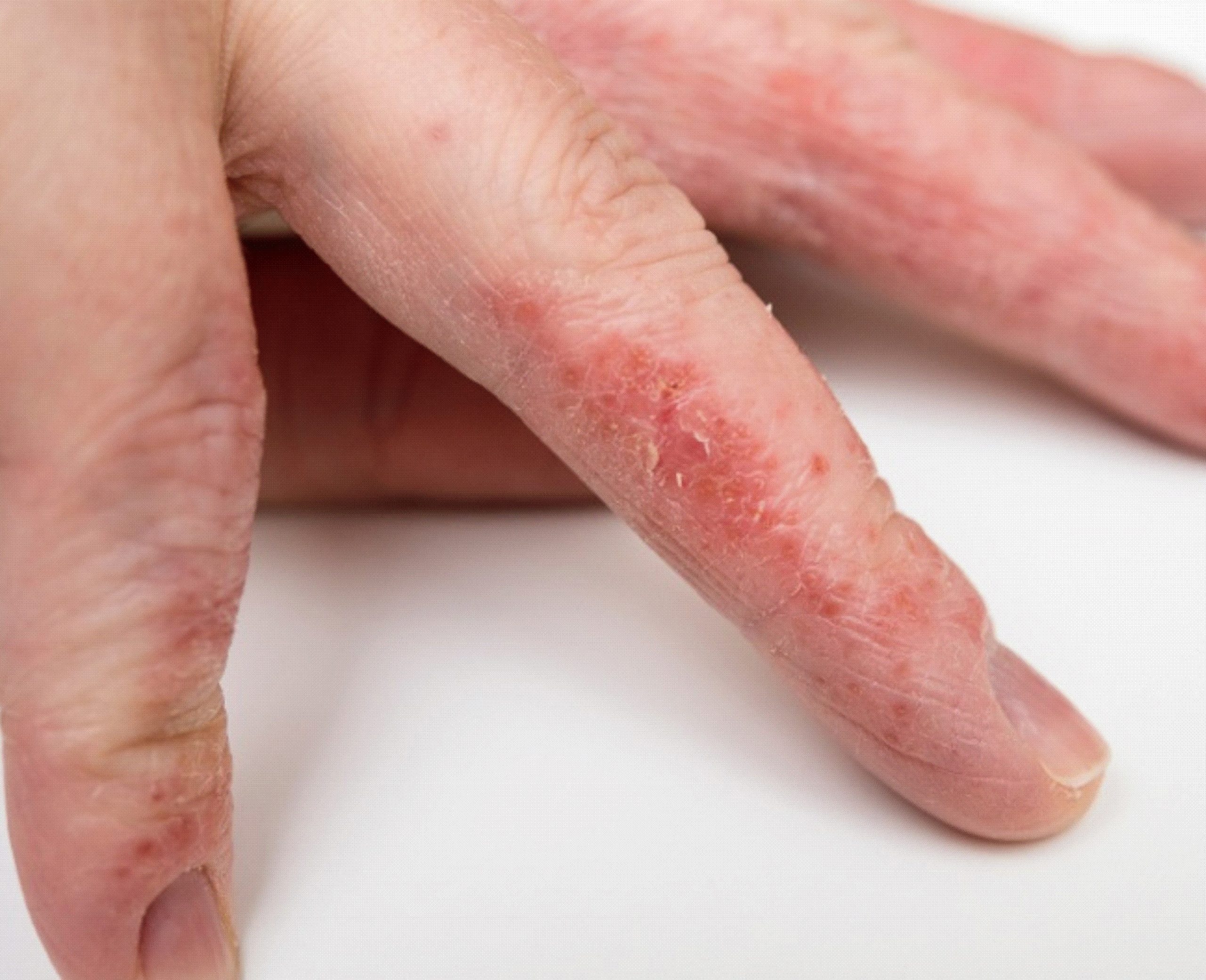 eczema and skin allergy dr health clinic scaled