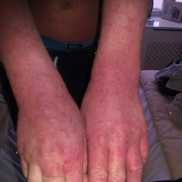Eczema and Steroid withdrawal