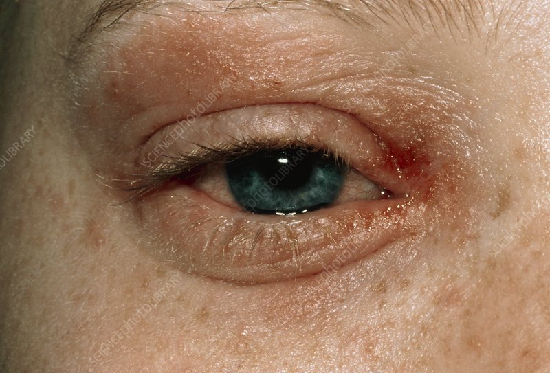 Eczema around eye of a patient