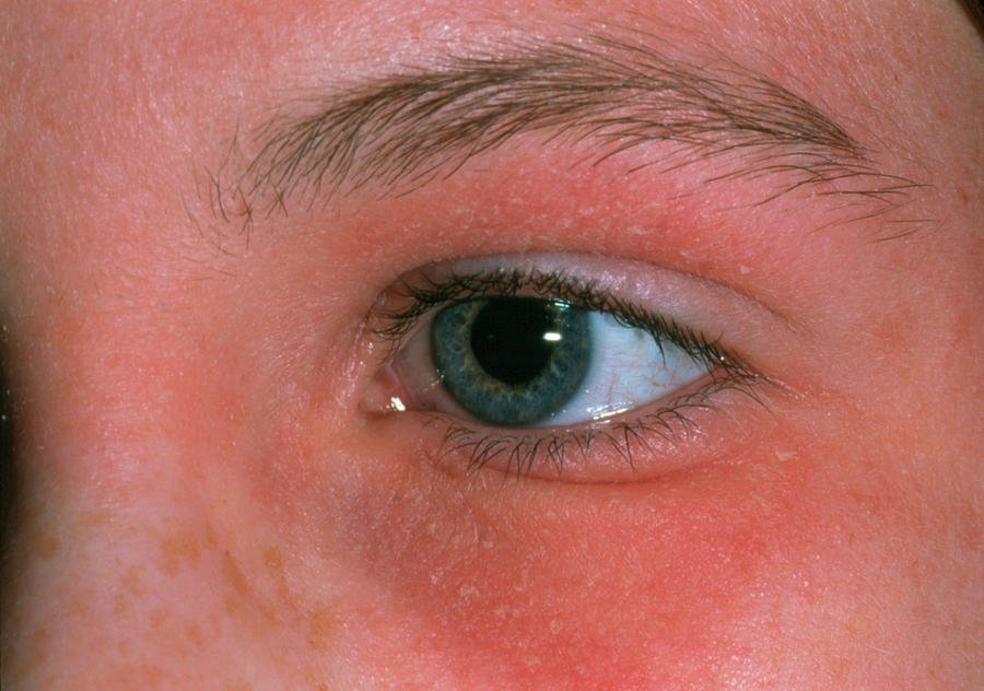 Eczema Around Eye Photograph by Dr P. Marazzi/science ...