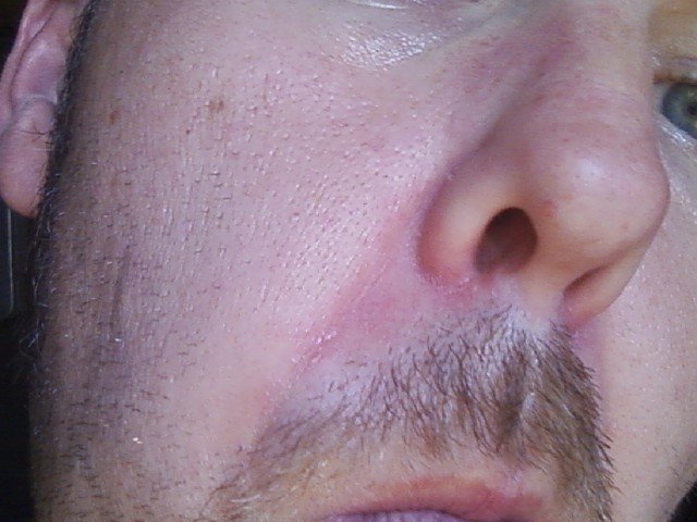 eczema around nose