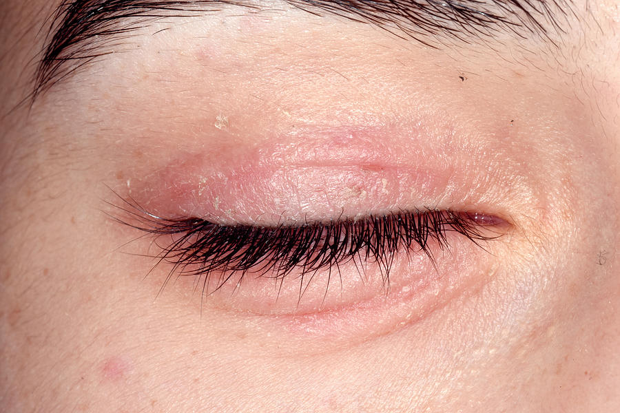 Eczema Around The Eye Photograph by Dr P. Marazzi/science ...