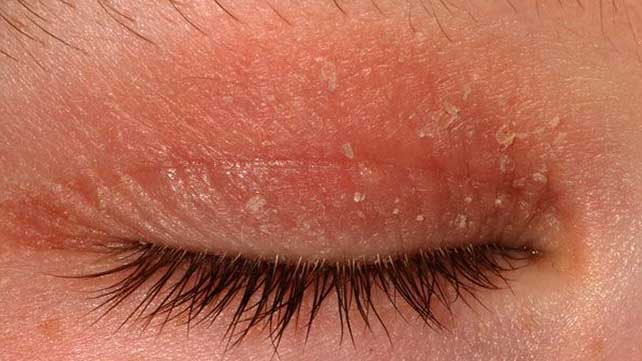 Eczema Around the Eyes: Treatment and More