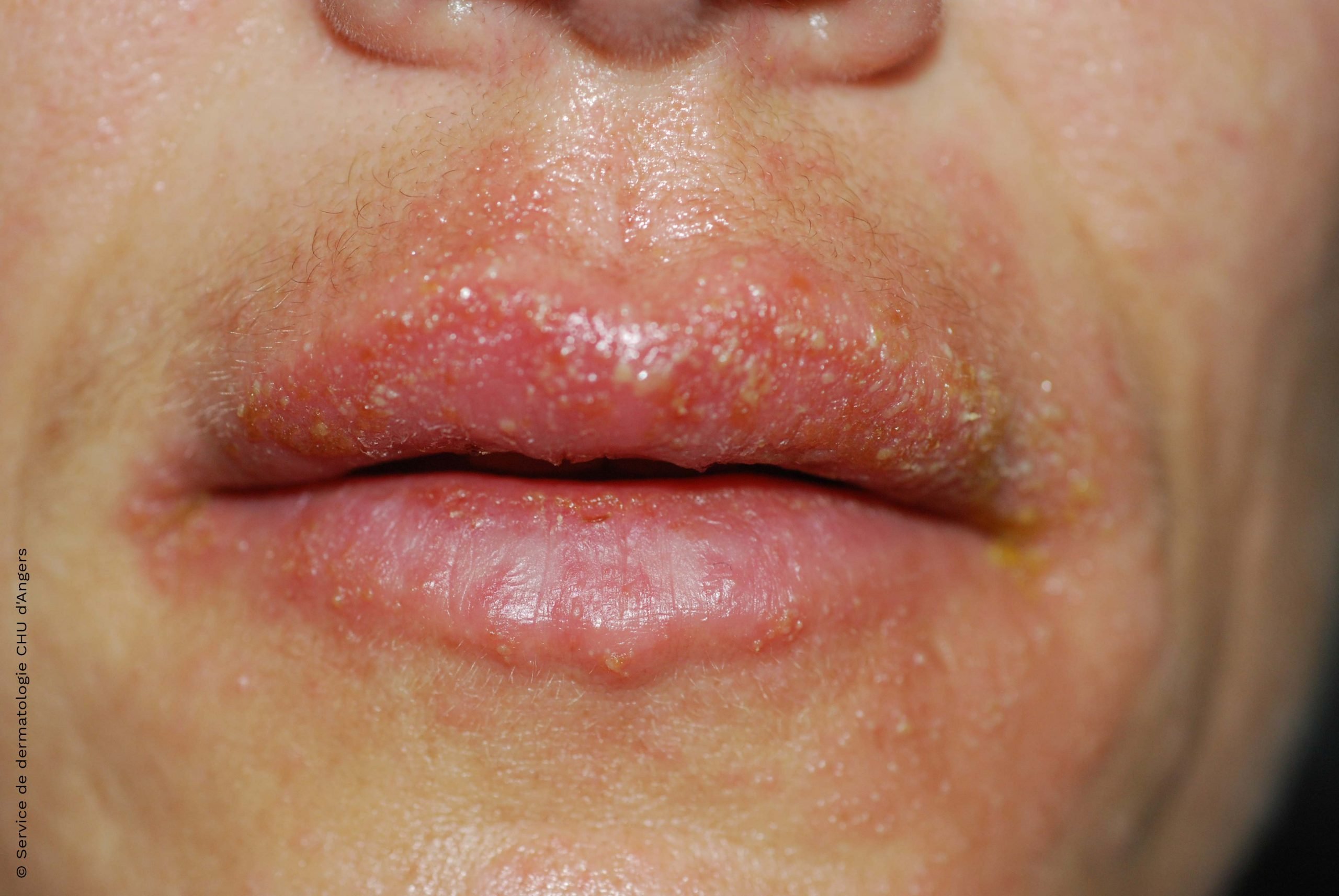 Eczema around the mouth