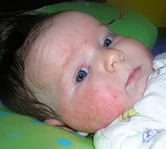 Eczema  Atopic Dermatitis  Skin Problems
