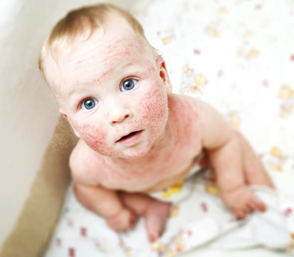 Eczema Awareness Week: 6 NATURAL ways to treat your baby