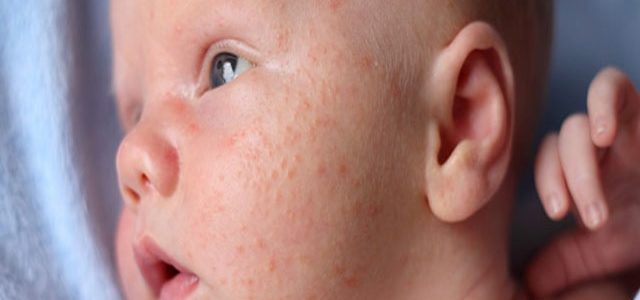 Eczema Baby Face Rash