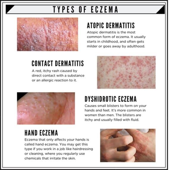Eczema: Basic Guide for Men