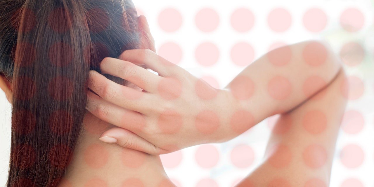 Eczema: behind the name, multiple diseases