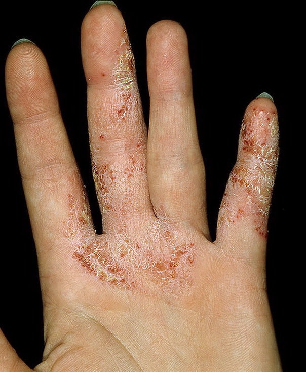 Eczema Between Fingers Pictures  105 Photos &  Images / illnessee.com