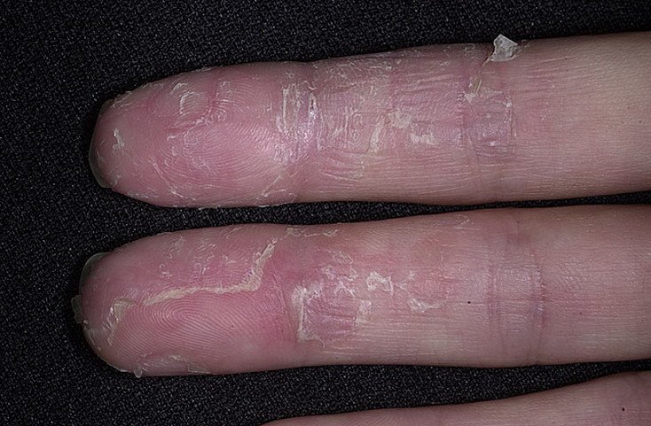 Eczema Between Fingers Pictures  105 Photos &  Images ...