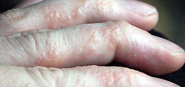 Eczema Blisters On Hands Treatment
