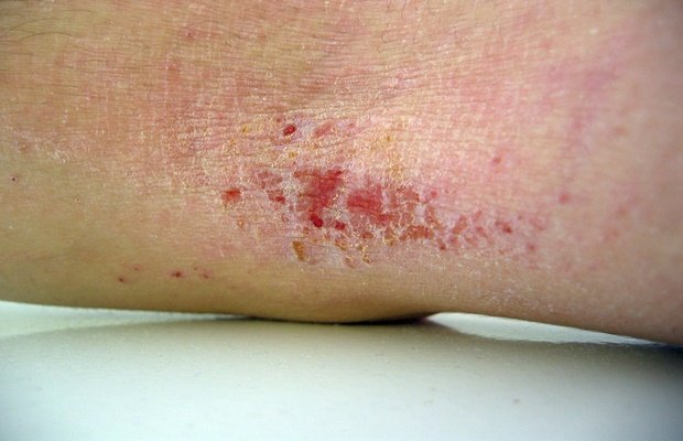 Eczema can be worse for adults