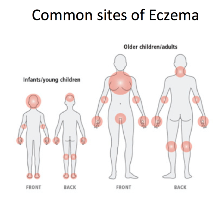 Eczema Care