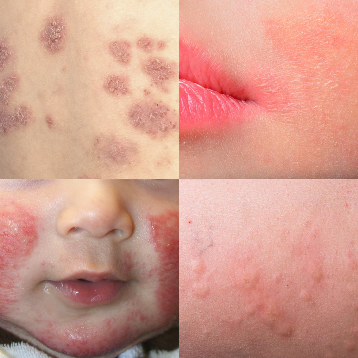 Eczema: causas, tipos, síntomas y tratamiento